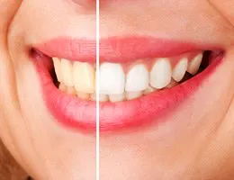 Teeth Whitening