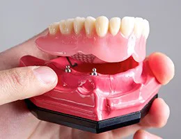 Implant-Retained Dentures